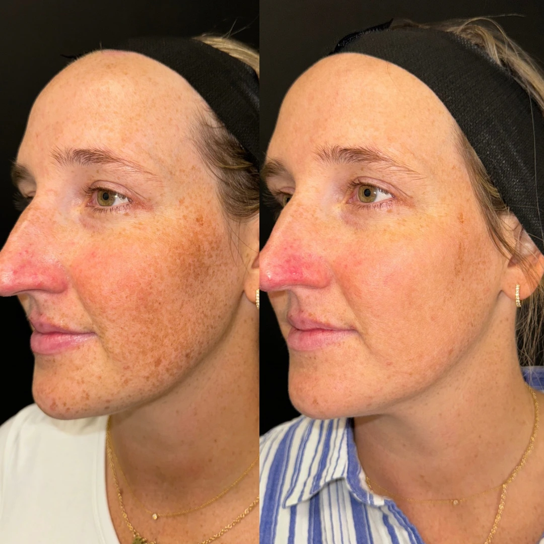 Before and after comparison of uneven skin tone treatment showing reduced redness and improved skin clarity